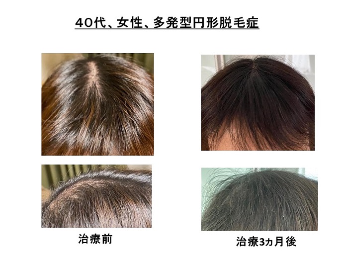 円形脱毛症　病院